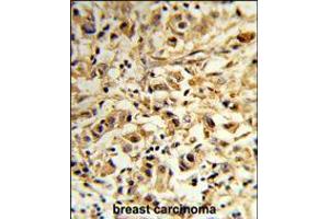 Formalin-fixed and paraffin-embedded human breast carcinoma reacted with MAT2B Antibody (N-term), which was peroxidase-conjugated to the secondary antibody, followed by DAB staining.