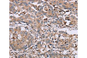 Immunohistochemistry of Human liver cancer using MAGEA3 Polyclonal Antibody at dilution of 1:50 (MAGEA3 anticorps)