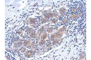 IHC-P Image Immunohistochemical analysis of paraffin-embedded human breast cancer, using SERPINB6 antibody, antibody at 1:500 dilution. (SERPINB6 anticorps  (Internal Region))