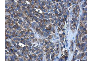 IHC-P Image PEX26 antibody detects PEX26 protein at cytoplasm in human cervical cancer by immunohistochemical analysis.