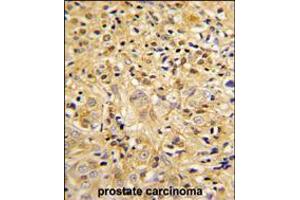 Formalin-fixed and paraffin-embedded human prostate carcinoma reacted with LUM Antibody , which was peroxidase-conjugated to the secondary antibody, followed by DAB staining. (LUM anticorps  (AA 198-227))