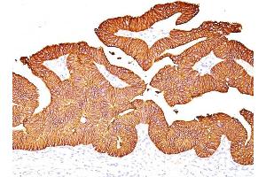Formalin-fixed, paraffin-embedded human Colon Carcinoma stained with EpCAM Mouse Monoclonal Antibody (EGP40/837). (EpCAM anticorps)