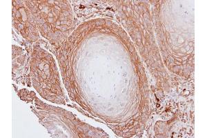 IHC-P Image Immunohistochemical analysis of paraffin-embedded Cal27 xenograft, using BAG3, antibody at 1:100 dilution.
