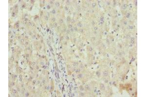 Immunohistochemistry of paraffin-embedded human liver cancer using ABIN7176188 at dilution of 1:100 (ZNF253 anticorps  (AA 80-300))