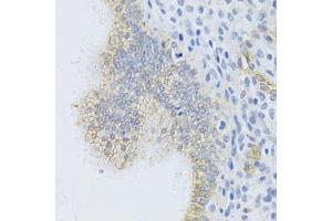 Immunohistochemistry of paraffin-embedded human uterine cancer using ABCC1 Antibody. (ABCC1 anticorps)