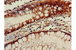 Immunohistochemistry of paraffin-embedded human colon cancer using ABIN7154664 at dilution of 1:100