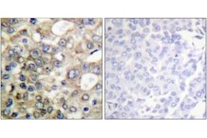 Immunohistochemistry analysis of paraffin-embedded human breast carcinoma, using CD227/MUC1 (Phospho-Tyr1229) Antibody. (MUC1 anticorps  (pTyr1229))