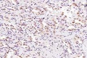 Immunohistochemistry analysis of paraffin-embedded human lung cancer using SRFBP1 (ABIN7075579) at dilution of 1: 2000