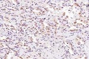 Immunohistochemistry analysis of paraffin-embedded human lung cancer using SRFBP1 (ABIN7075579) at dilution of 1: 2000 (SRFBP1 anticorps)