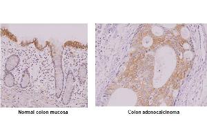 Paraffin embedded sections of normal colon mucosa and colon adenocalcinoma tissue were incubated with anti-human IRF-5 antibody (1:50) for 2 hours at room temperature. (IRF5 anticorps)