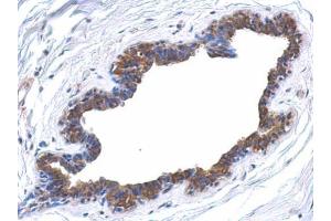 IHC-P Image Immunohistochemical analysis of paraffin-embedded human breast cancer, using MAPK4, antibody at 1:500 dilution.