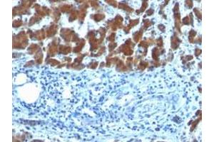 Immunohistochemical staining (Formalin-fixed paraffin-embedded sections) of human hepatocellular carcinoma with Retinol Binding Protein monoclonal antibody, clone SPM442 . (Retinol-Binding Protein anticorps)