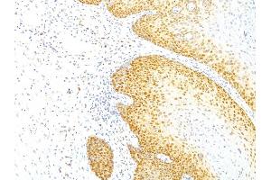 Formalin-fixed, paraffin-embedded human Cervical Carcinoma stained with p27 Mouse Monoclonal Antibody (KIP1/769).
