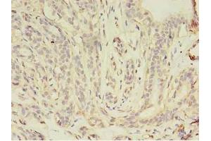 Immunohistochemistry of paraffin-embedded human breast cancer using ABIN7157158 at dilution of 1:100