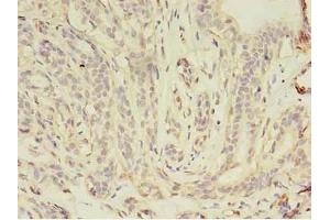 Immunohistochemistry of paraffin-embedded human breast cancer using ABIN7157158 at dilution of 1:100 (JUP anticorps  (AA 1-131))