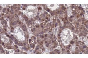 ABIN6273912 at 1/100 staining Human liver cancer tissue by IHC-P. (GPR77 anticorps  (C-Term))