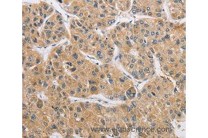 Immunohistochemistry of Human liver cancer using ARHGAP15 Polyclonal Antibody at dilution of 1:50 (ARHGAP15 anticorps)
