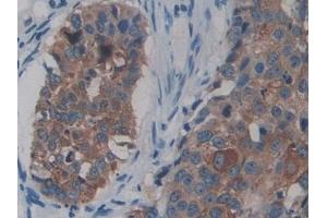Detection of NEIL1 in Human Lung cancer Tissue using Polyclonal Antibody to Nei Endonuclease VIII Like Protein 1 (NEIL1)