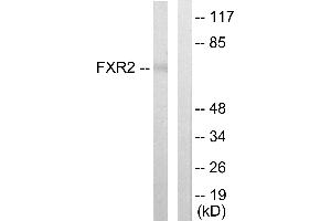 Immunohistochemistry analysis of paraffin-embedded human lung carcinoma tissue using FXR2 antibody. (FXR2 anticorps  (Internal Region))