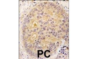 Formalin-fixed and paraffin-embedded human prostata carcinoma tissue reacted with CKK2 antibody (N-term) (ABIN391182 and ABIN2841279) , which was peroxidase-conjugated to the secondary antibody, followed by DAB staining. (CAMKK2 anticorps  (N-Term))