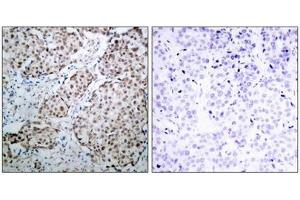 Immunohistochemical analysis of paraffin-embedded human breast carcinoma tissue using p53(Phospho-Ser315) Antibody(left) or the same antibody preincubated with blocking peptide(right).