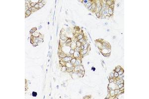 Immunohistochemistry of paraffin-embedded human gastric cancer using IER3 antibody at dilution of 1:100 (x40 lens).
