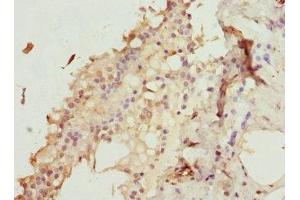 Immunohistochemistry of paraffin-embedded human breast cancer using ABIN7176187 at dilution of 1:100 (ZNF24 anticorps  (AA 169-368))