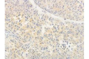 ABIN6264552 and ABIN6276570 at 1/100 staining human lung squamous cell carcinoma by IHC-P. (RAB11A anticorps  (C-Term))