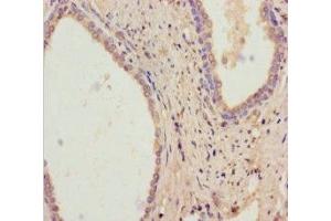 Immunohistochemistry of paraffin-embedded human prostate cancer using ABIN7167832 at dilution of 1:100 (RDH11 anticorps  (AA 22-318))