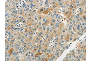 The image on the left is immunohistochemistry of paraffin-embedded Human liver cancer tissue using ABIN7193065(WNT2B Antibody) at dilution 1/20, on the right is treated with synthetic peptide. (WNT2B anticorps)