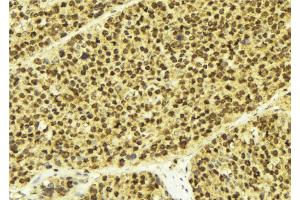 ABIN6268873 at 1/100 staining Human breast cancer tissue by IHC-P.