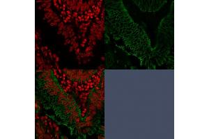 Confocal Immunofluorescence of human Colo-rectal Carcinoma. (EpCAM anticorps  (Extracellular Domain))