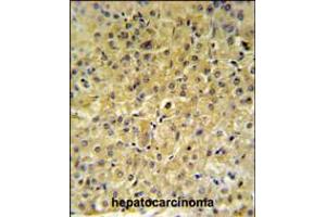 INSC Antibody IHC analysis in formalin fixed and paraffin embedded hepatocarcinoma followed by peroxidase conjugation of the secondary antibody and DAB staining. (INSC anticorps  (AA 410-437))