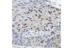 Immunohistochemistry of paraffin-embedded human esophageal cancer using SUFU Rabbit pAb (ABIN6133029, ABIN6148692, ABIN6148694 and ABIN6217424) at dilution of 1:100 (40x lens).