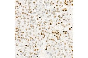 Immunohistochemistry of paraffin-embedded human liver cancer using Phospho-POLR2A CTD-S5 Rabbit mAb  at dilution of 1:200 (40x lens). (POLR2A/RPB1 anticorps  (pSer5))