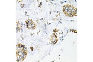 Immunohistochemistry of paraffin-embedded human gastric cancer using GALC antibody at dilution of 1:100 (x40 lens). (GALC anticorps)