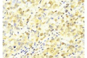 ABIN6277569 at 1/100 staining Human breast cancer tissue by IHC-P. (HUS1 anticorps  (Internal Region))