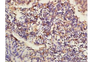 Formalin-fixed and paraffin embedded human laryngo carcinoma labeled with Rabbit Anti-DNAJB12 Polyclonal Antibody, Unconjugated (ABIN2173711) at 1:200 followed by conjugation to the secondary antibody and DAB staining (DNAJB12 anticorps  (AA 26-130))