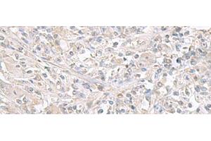 Immunohistochemistry of paraffin-embedded Human liver cancer tissue using FXYD6 Polyclonal Antibody at dilution of 1:65(x200) (FXYD6 anticorps)