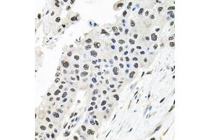 Immunohistochemistry of paraffin-embedded human lung cancer using CDCA8 antibody (ABIN6290179) at dilution of 1:100 (40x lens). (CDCA8 anticorps)
