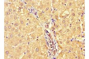 Immunohistochemistry of paraffin-embedded human liver cancer using ABIN7143724 at dilution of 1:100