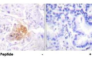 Immunohistochemical analysis of paraffin-embedded human lung carcinoma tissue using IL2RB polyclonal antibody . (IL2 Receptor beta anticorps)