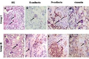 Expression of E-cadherin, N-cadherin, and vimentin in single stroma PGCCs of human breast cancer.