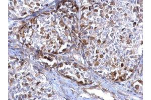 IHC-P Image Rad51 antibody [N1C2] detects Rad51 protein at nucleus on human breast carcinoma by immunohistochemical analysis.