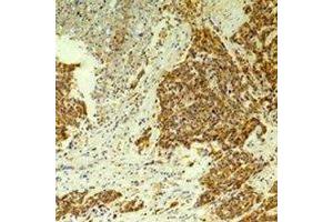 Immunohistochemical analysis of CLIC4 staining in human breast cancer,rat brain formalin fixed paraffin embedded tissue section. (CLIC4 anticorps)