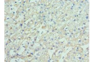 Immunohistochemistry of paraffin-embedded human liver cancer using ABIN7151389 at dilution of 1:100 (ENPP2 anticorps  (AA 564-863))