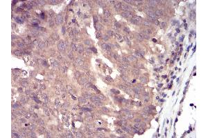 Immunohistochemical analysis of paraffin-embedded ovarian cancer tissues using SLINGSHOT-1L mouse mAb with DAB staining. (SSH1 anticorps  (AA 1032-1044))
