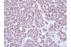IHC-P Image Immunohistochemical analysis of paraffin-embedded SW480 xenograft, using NSMCE1, antibody at 1:500 dilution.