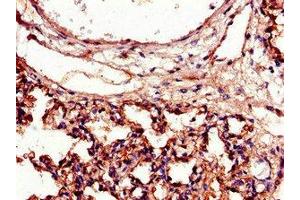 Immunohistochemistry of paraffin-embedded human lung tissue using ABIN7156533 at dilution of 1:100 (ICAM1 anticorps  (AA 320-480))