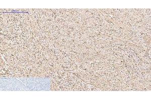 Immunohistochemistry of paraffin-embedded Human uterus cancer tissue using PRDX1 Monoclonal Antibody at dilution of 1:200. (Peroxiredoxin 1 anticorps)